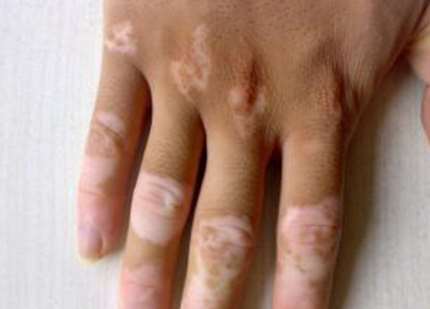 vitiligo symptom