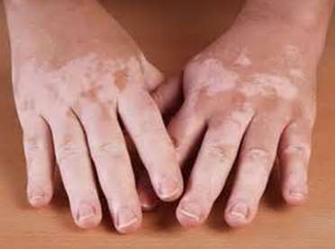 vitiligo causes