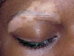 Various Causes for Vitiligo