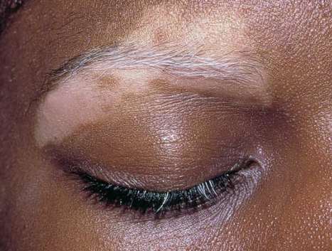 Various Causes for Vitiligo,Vitiligo