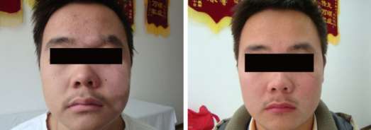 6-year Vitiligo Recovery Case in CASU Vitiligo Hospital,Vitiligo