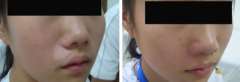 Face Vitiligo Recovery Case