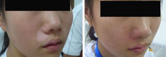 Face Vitiligo Recovery Case,Vitiligo 