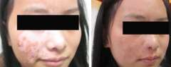 10-year Female Face Vitiligo Recovery Case