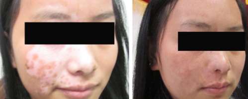 10-year Female Face Vitiligo Recovery Case,Vitiligo