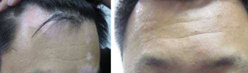 Forehead Vitiligo Recovery Case with TCM Therapy,vitiligo