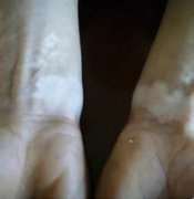 The effective treatment for acral vitiligo