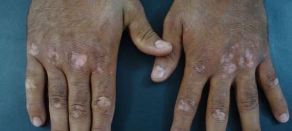 acral vitiligo