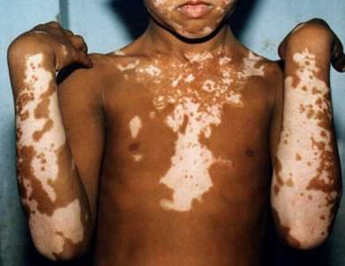 vitiligo patches