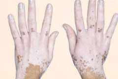 What are the causes of vitiligo