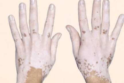 vitiligo causes