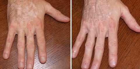 vitiligo treatment