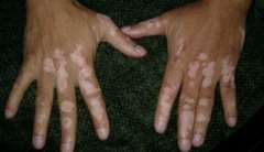 Is vitiligo directly related to blood