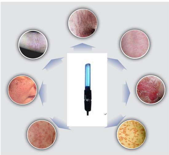  Treatment of vitiligo