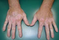 The Complications of Vitiligo Patients