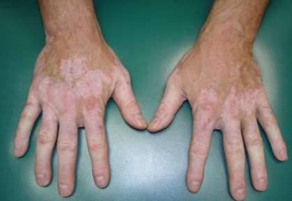 vitiligo complications