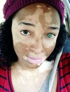 vitiligo treatment