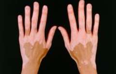 Is Vitiligo A Contagious Disease