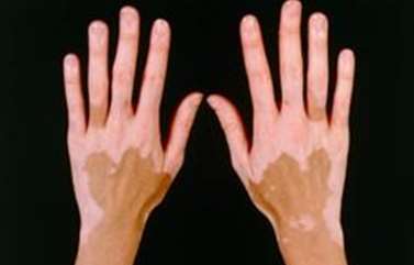 vitiligo