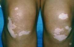 Complications of Vitiligo