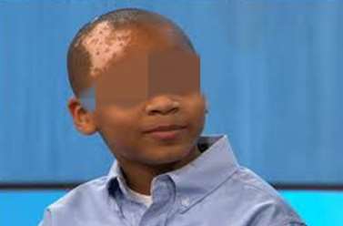 Children vitiligo patients