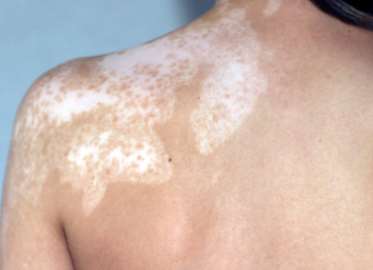 The Treatment Method for Acral Type Vitiligo