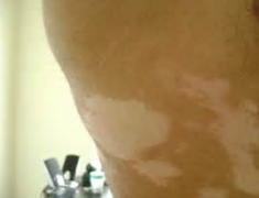 What Is The Symptom of Vitiligo on Waist