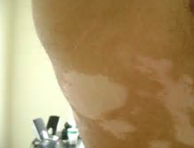 vitiligo symptom on waist