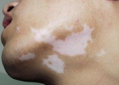 Vitiligo: Autoantigens Trigger Autoimmunit