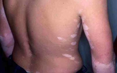 vitiligo treatment