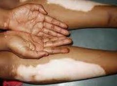 Will Improper Treatment Lead to Vitiligo Sp