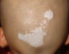 How To Treat Vitiligo on Head