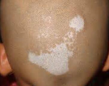 vitiligo on head