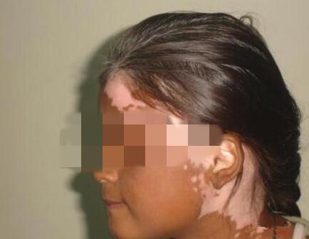 Teenager vitiligo patients