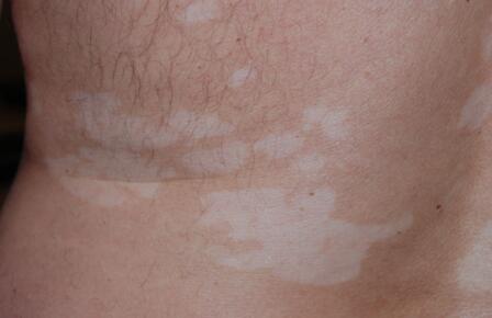 Late Period  Vitiligo symptoms