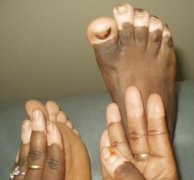 Why Some Vitiligo Patients’ Recovery Proc