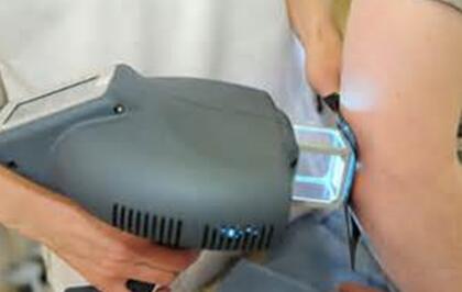 laser treatment for vitiligo