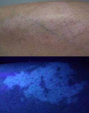 Choose Proper Treatment for Vitiligo