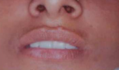 Epidermal Grafts for Lip Vitiligo