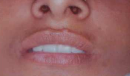 epidermal grafts for lip vitiligo