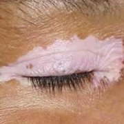 How Will Vitiligo Affect Human Eyesight