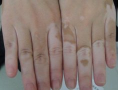 Adjust Vitiligo Children’s Psychological