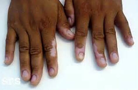 distributing type of vitiligo