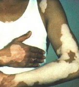 How to Decrease Vitiligo Heritability for V