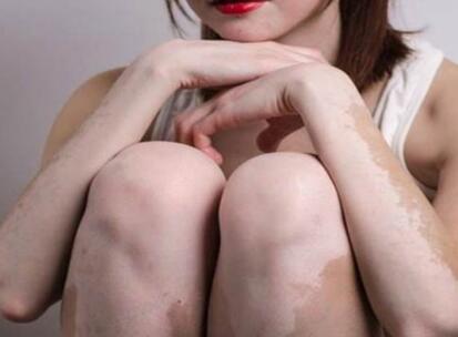 vitiligo treatment