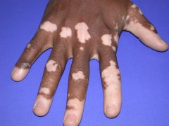 Some Common Symptoms of Vitiligo