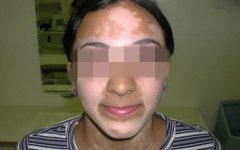 Therapeutic Principle for Vitiligo on Face