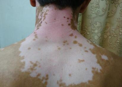 comprehensive treatment for vitiligo