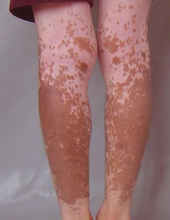 vitiligo staging treatment