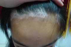 Vitiligo Successful Story:A Young Girl Trea